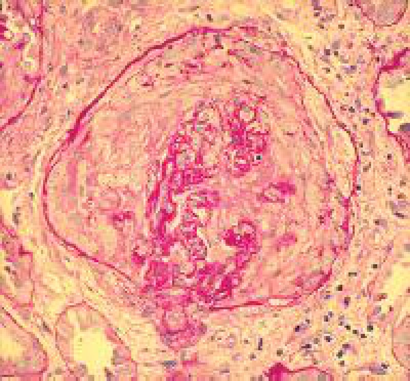 Rasch progrediente Glomerulonephritis: Ein nephrologischer