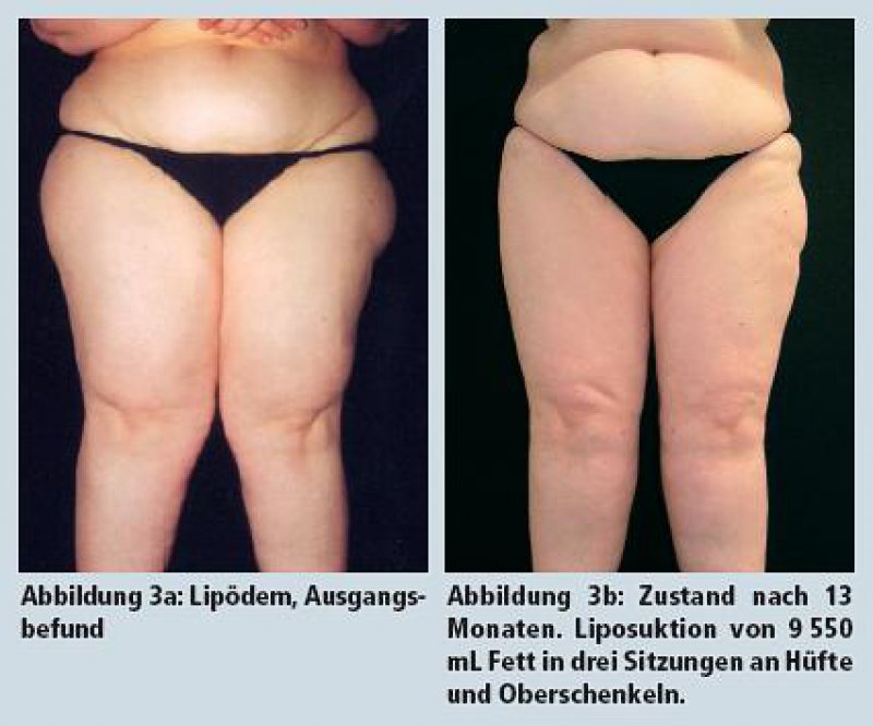 Lipodem Verbesserte Lebensqualitat Durch Therapiekombination