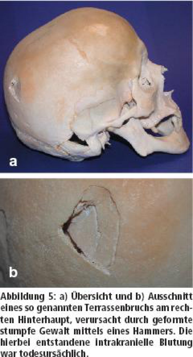 Forensische Anthropologie Und Osteologie Ubersicht Und Definitionen