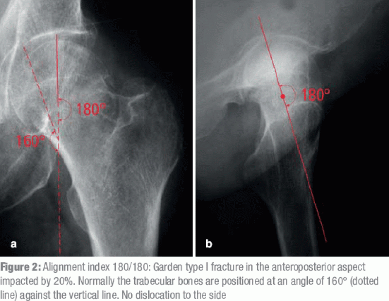 Fractured Neck Of Femur 11062010