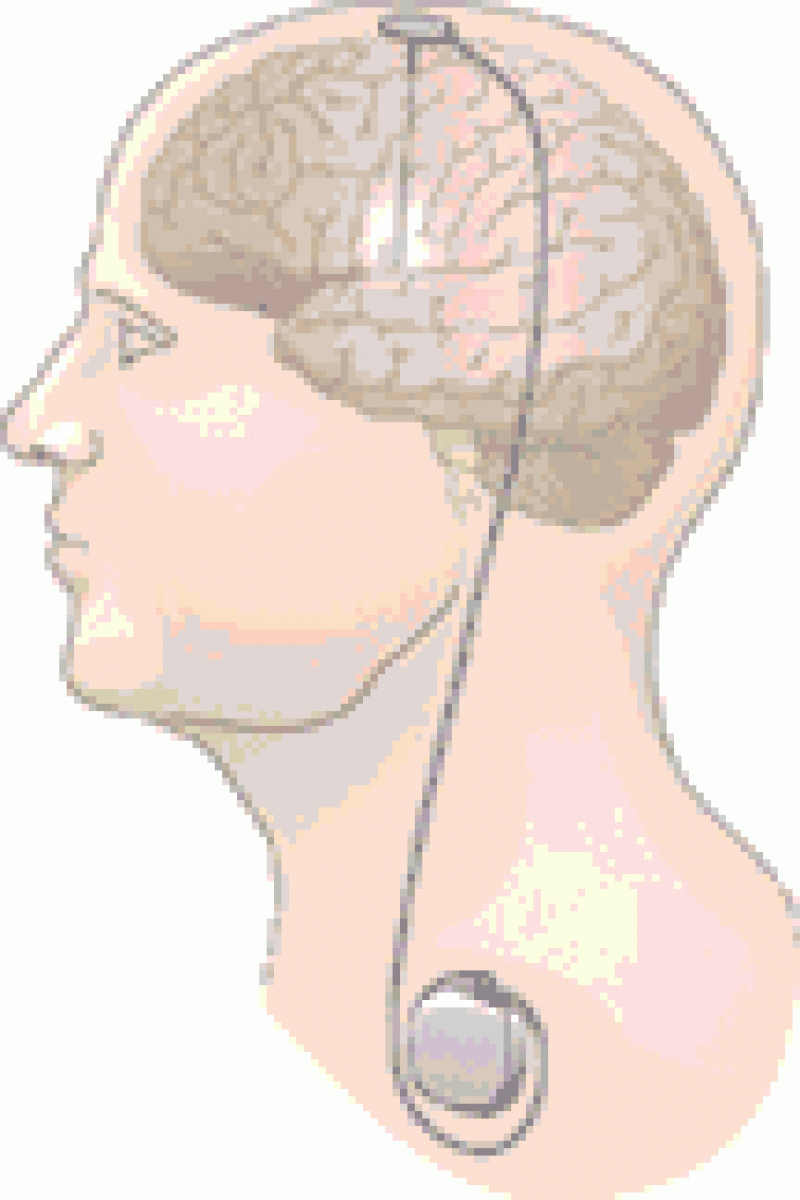 Parkinson Beide Tiefenhirnstimulationen Gleichwertig