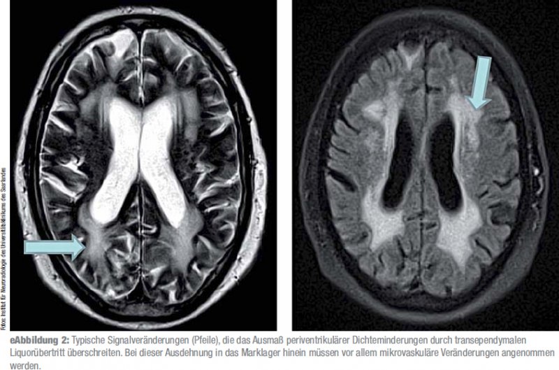 Differenzialdiagnose Und Therapie Des Normaldruckhydrozephalus