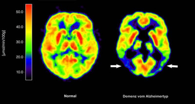 Alzheimer Plaques Gehen Demenz Um Bis 30 Jahre Voraus