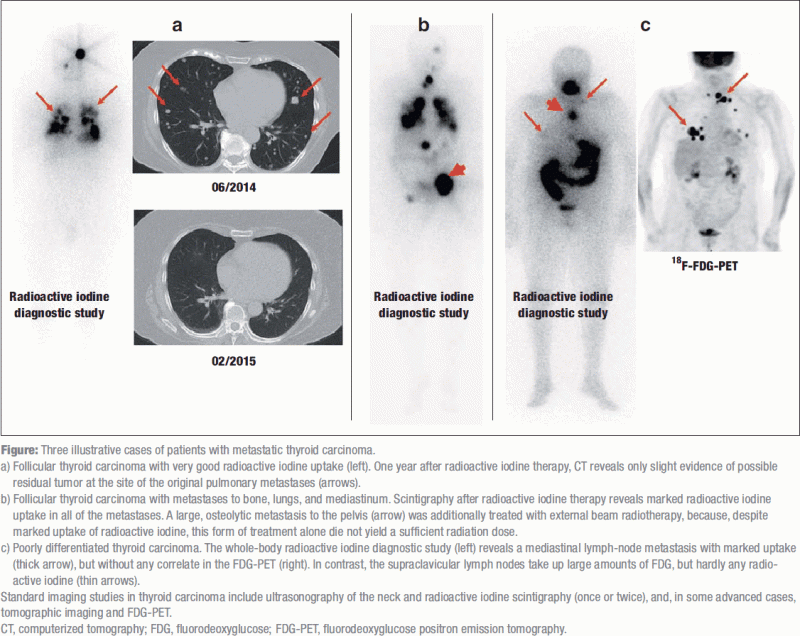 The Treatment Of Well Differentiated Thyroid Carcinoma 26 06 2015