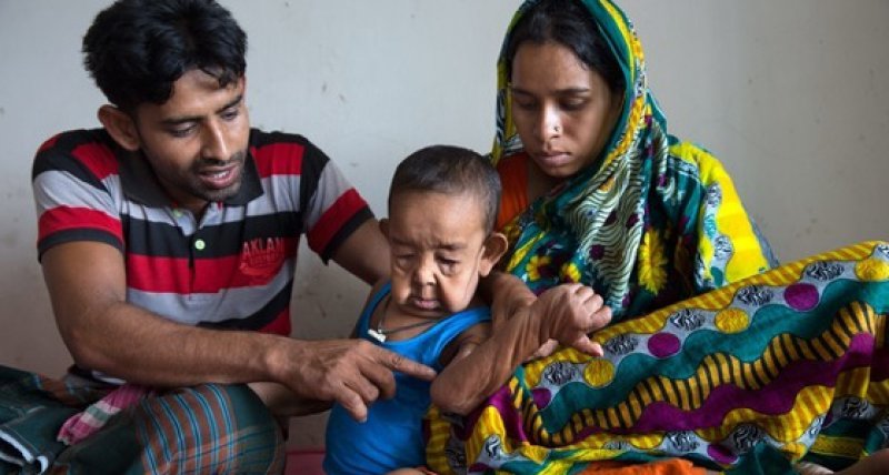 Ärzte in Bangladesch rätseln über seltsame Alterung eines Vierjährigen