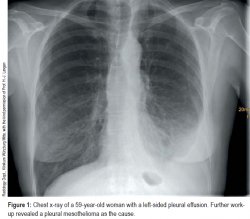 Pleural Effusion In Adults Etiology Diagnosis And Treatment 24 05 2019