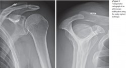 Postoperatieve röntgenfoto van een artroscopische stabilisatie met behulp van de katrolimplantaattechniek