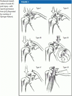 Rockwood classification of acute AC joint injury-with reprint permission from (Reprinted by courtesy of Springer Nature).