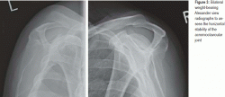 Radiografie bilaterali in carico Alexander view per valutare la stabilità orizzontale dell'articolazione acromio clavicolare