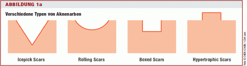 Dermatose Wenn Akne Spuren Hinterlasst