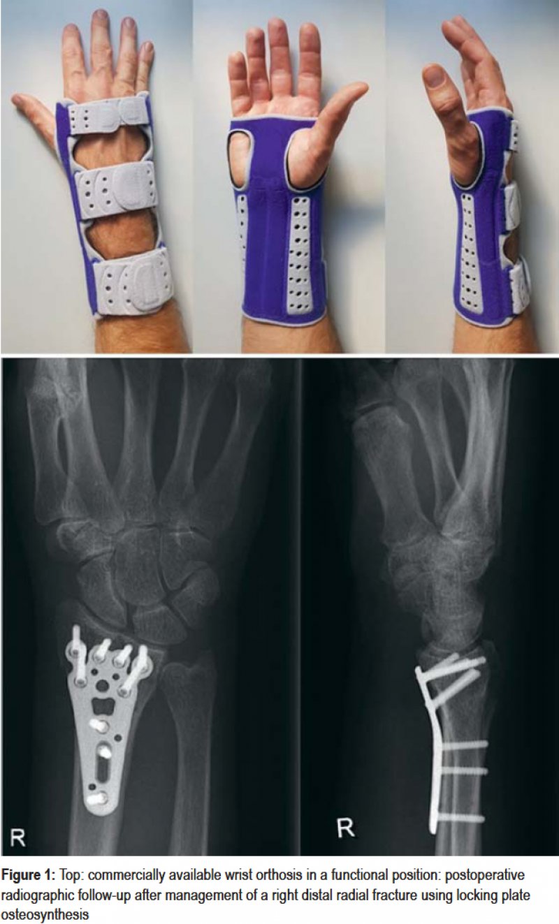 Early Mobilization Versus Splinting After Surgical Management Of Distal Radius Fractures 26 06 2020