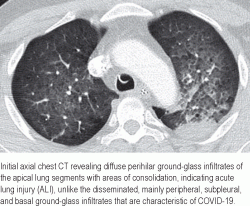 Inhalation and Ingestion of Disinfectant as a Mimic of COVID-19 ...